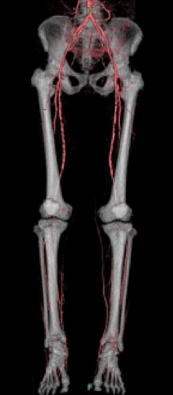 下肢CTA
